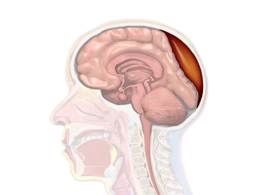 epiduralen-Hematom